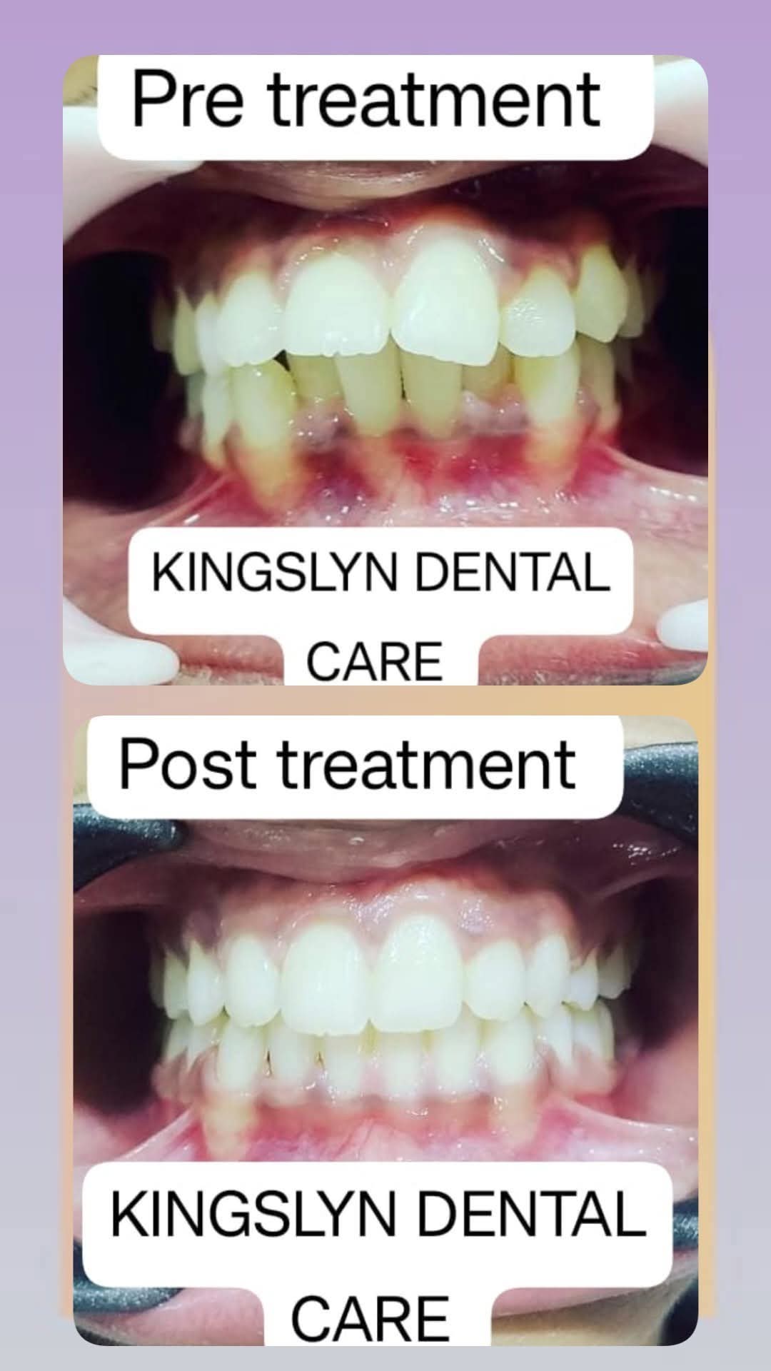 Orthodontic Alignment
