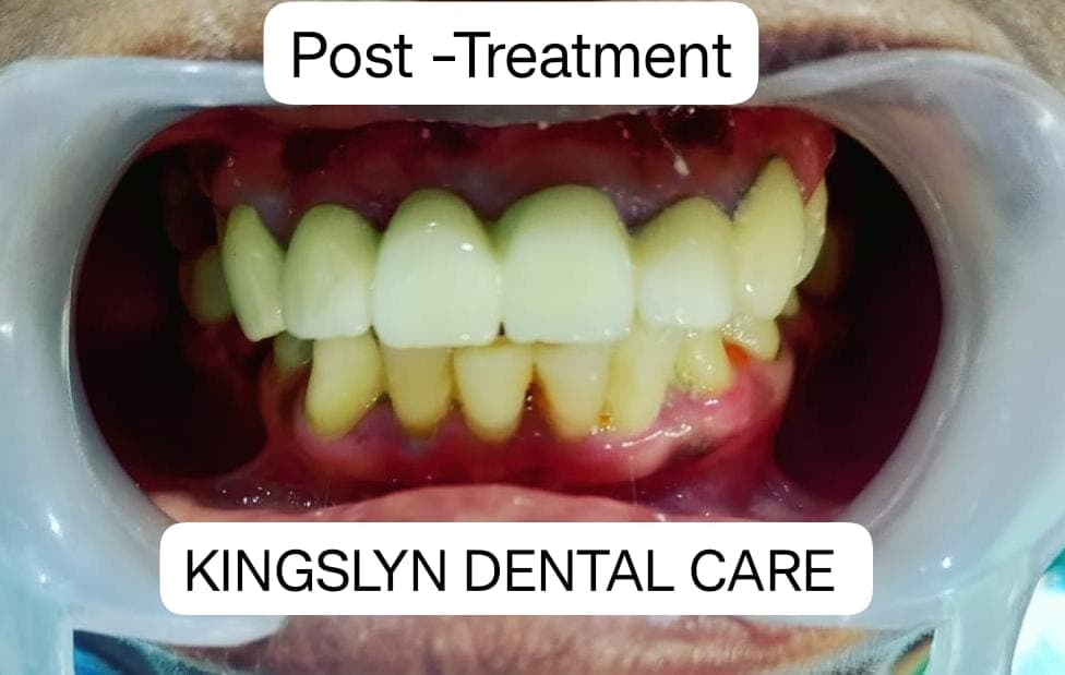 Dental Bridges