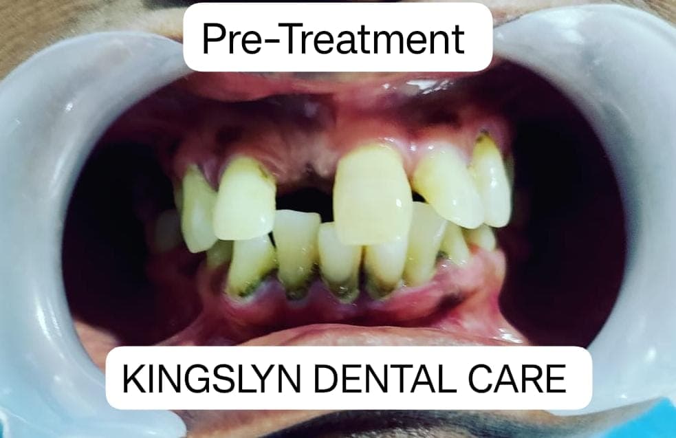 Dental Bridges