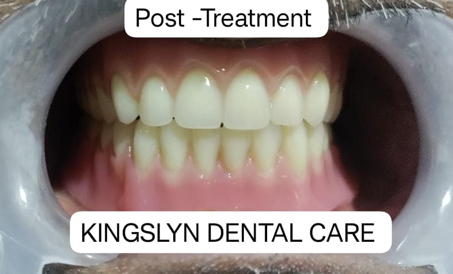 Complete Dentures