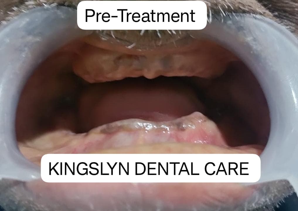 Complete Dentures