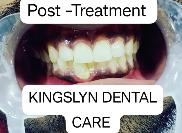 Cosmetic Composite Filling