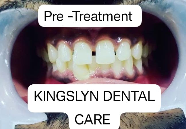 Cosmetic Composite Filling