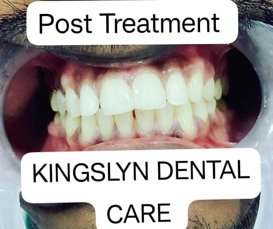 Esthetic Tooth Restoration