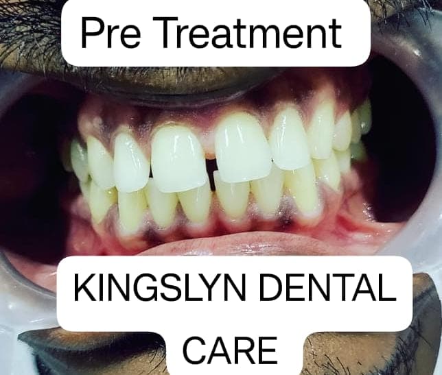 Esthetic Tooth Restoration