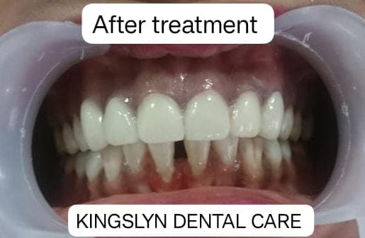 Esthetic Crowns