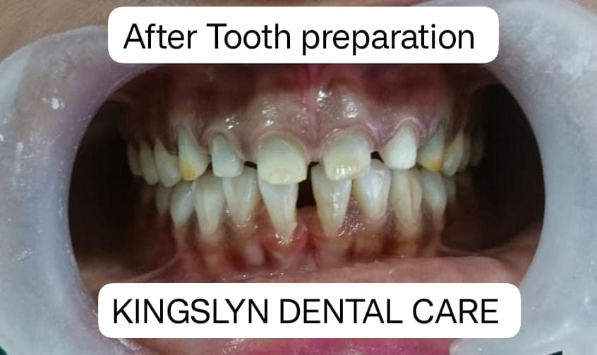 Esthetic Crowns