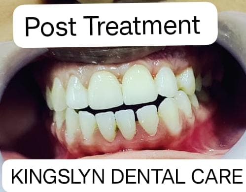 Ceramic Crowns