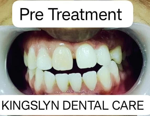 Ceramic Crowns