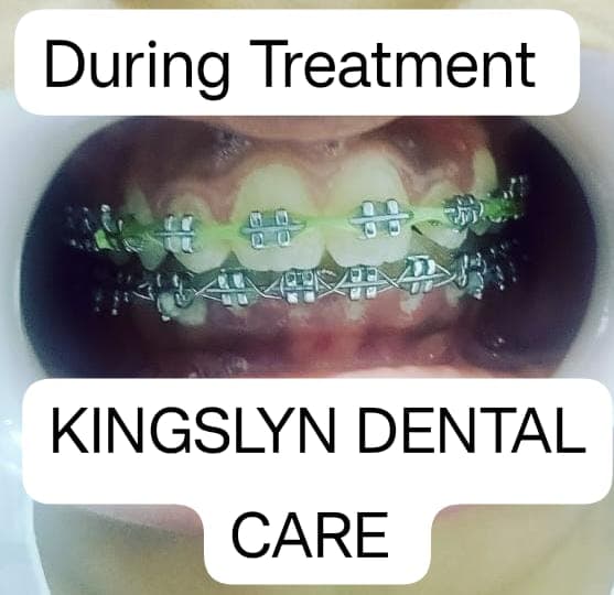 Metal Braces Orthodontics