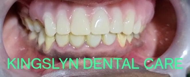 Removable Partial Dentures