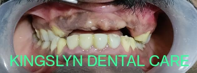 Removable Partial Dentures