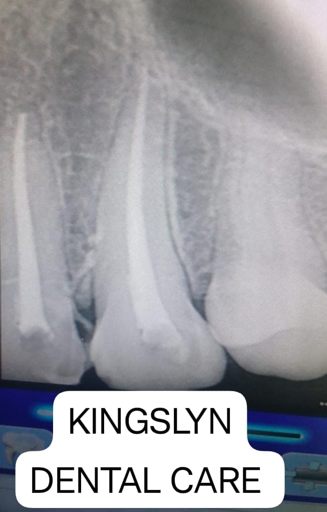 Root Canal Treatment