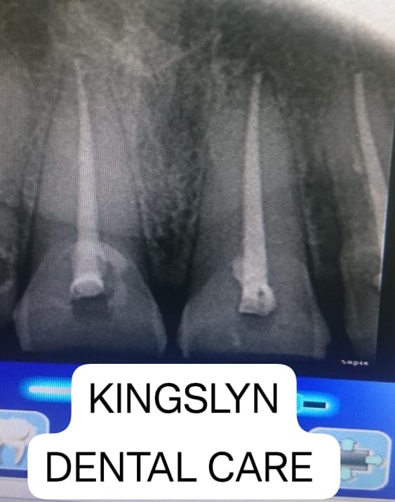 Root Canal Treatment