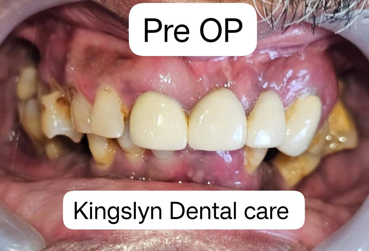 Full Mouth Rehabilitation (All-on-4 / All-on-6 Implants)
