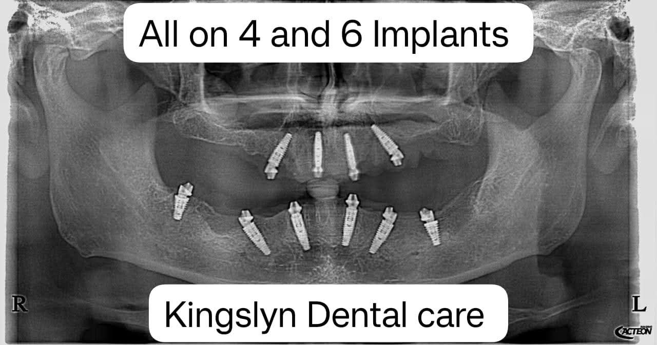 Full Mouth Rehabilitation (All-on-4 / All-on-6 Implants)