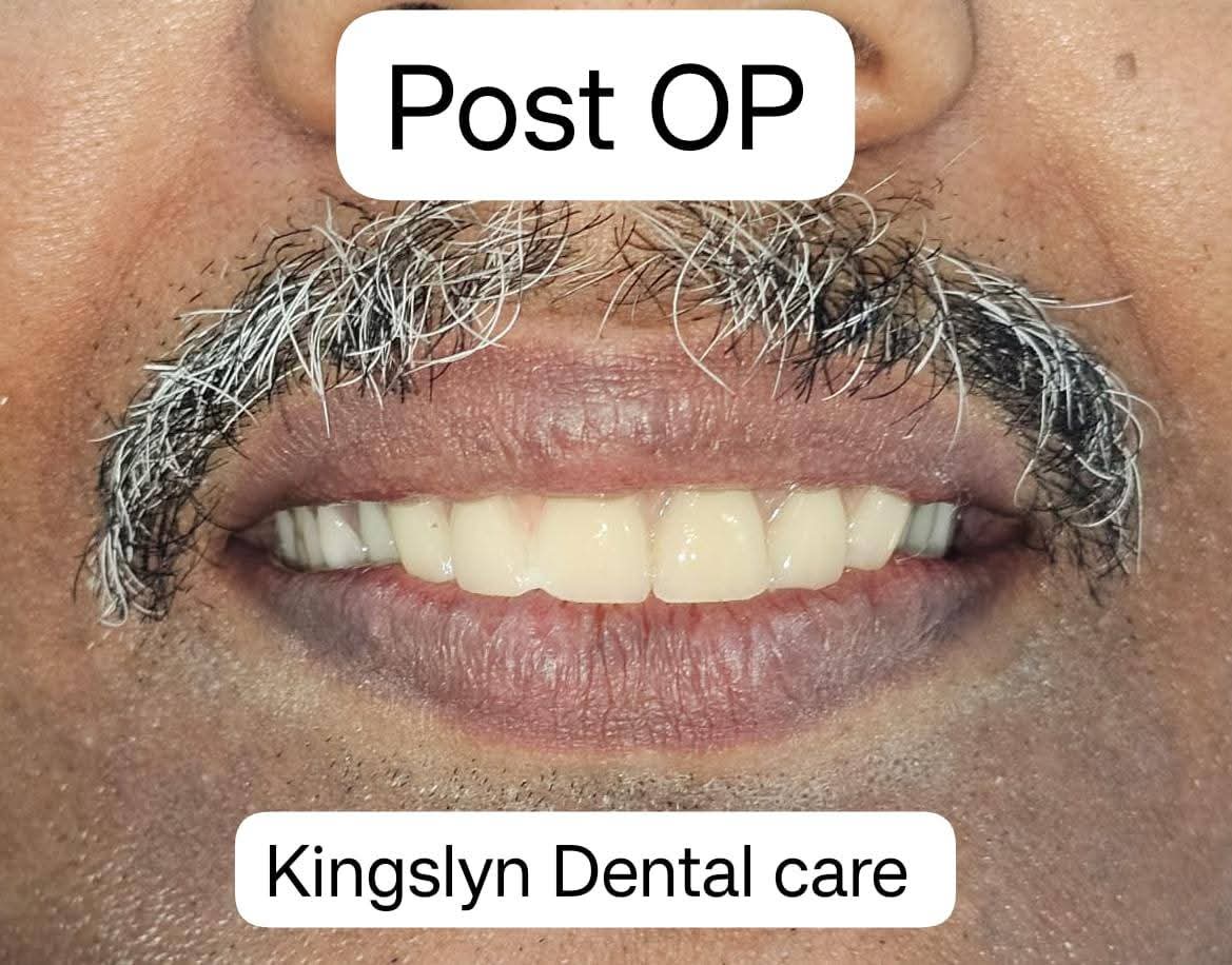 Full Mouth Rehabilitation (All-on-4 / All-on-6 Implants)